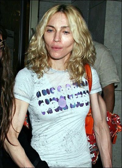 Madonna Plastic Surgery