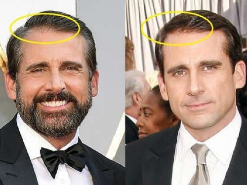 Steve Carell Plastic Surgery