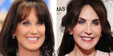 Robin Mcgraw Plastic Surgery