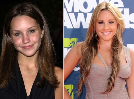 Amanda Bynes Plastic Surgery