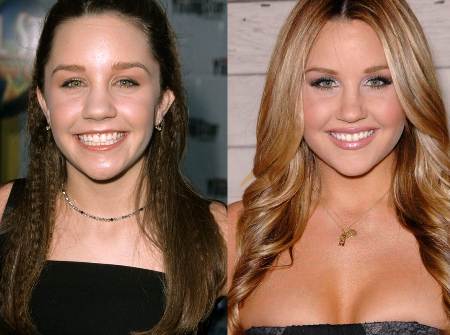 Amanda Bynes Plastic Surgery