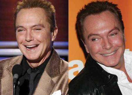 David Cassidy Plastic Surgery