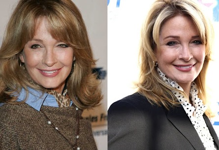 Deidre Hall Plastic Surgery