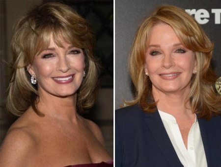 Deidre Hall Plastic Surgery