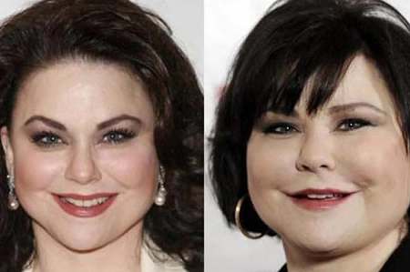 Delta Burke Plastic Surgery