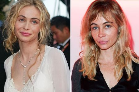 Emmanuelle Beart Plastic Surgery