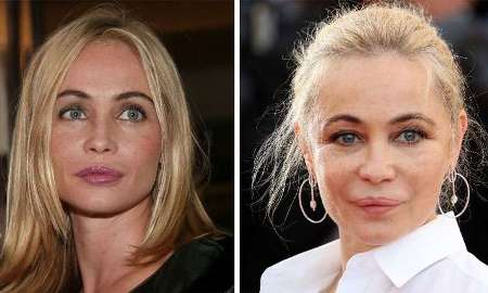 Emmanuelle Beart Plastic Surgery