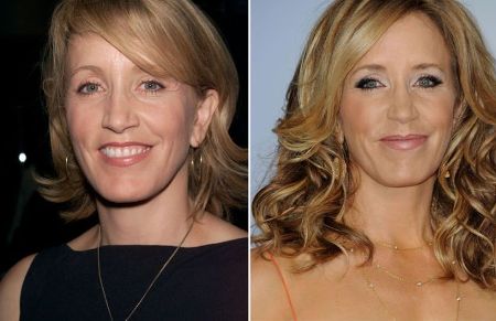 Felicity Huffman Plastic Surgery