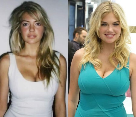 Kate Upton Plastic Surgery