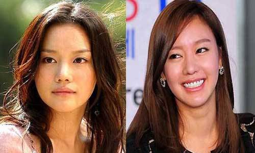 Kim Ah Joong Plastic Surgery