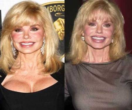 Loni Anderson Plastic Surgery