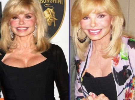 Loni Anderson Plastic Surgery