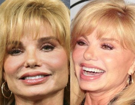 Loni Anderson Plastic Surgery