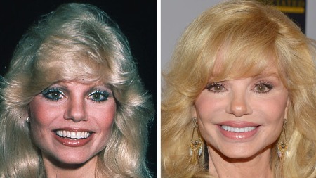 Loni Anderson Plastic Surgery