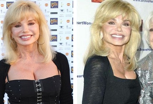 Loni Anderson Plastic Surgery