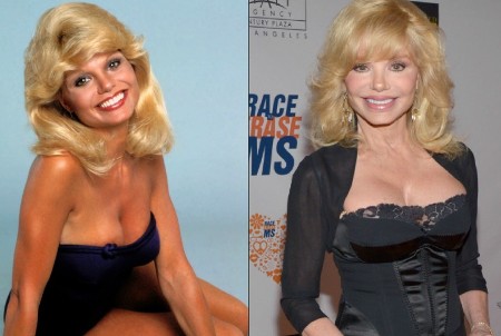 Loni Anderson Plastic Surgery