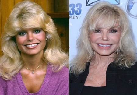 Loni Anderson Plastic Surgery