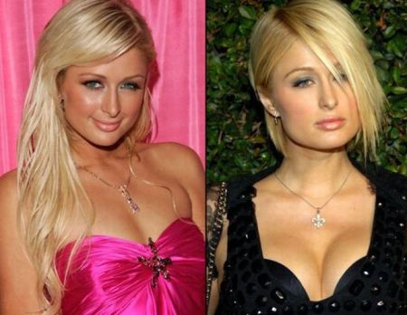 Paris Hilton Breast Implants