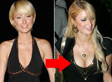 Paris Hilton Breast Implants