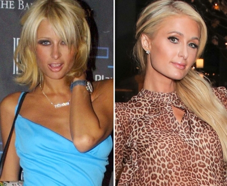 Paris Hilton Breast Implants