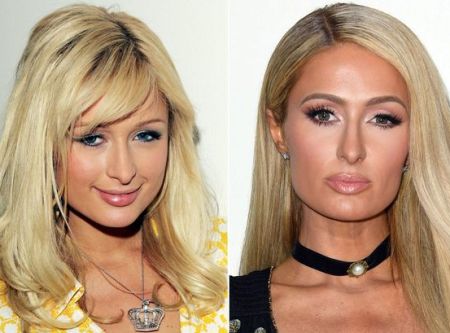 Paris Hilton Breast Implants