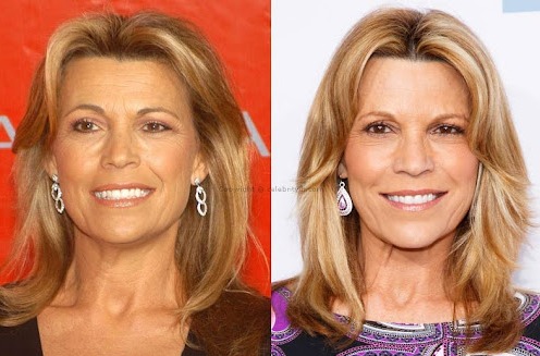 Vanna White Plastic Surgery