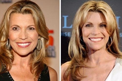 Vanna White Plastic Surgery