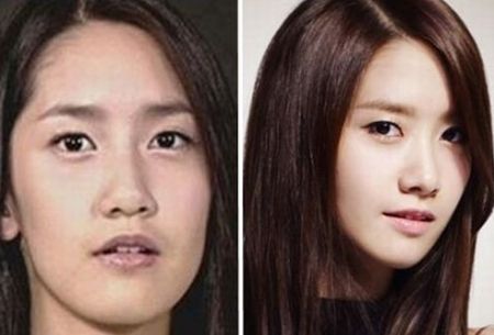 Yoona Plastic Surgery