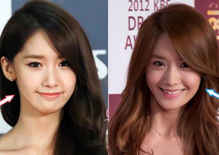 Yoona Plastic Surgery