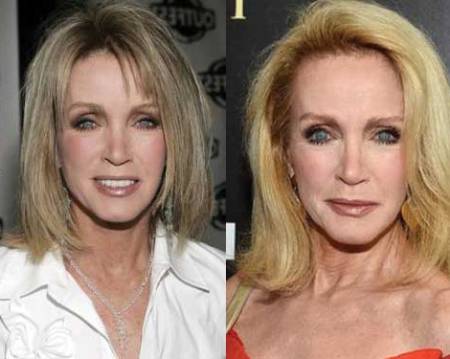 Donna Mills Plastic Surgery