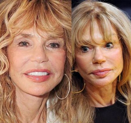 Dyan Cannon Plastic Surgery