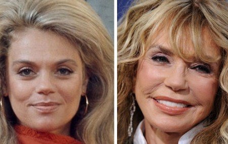 Dyan Cannon Plastic Surgery