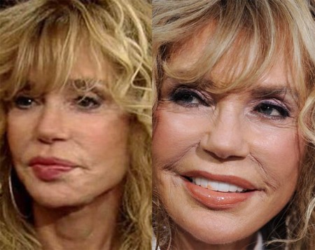 Dyan Cannon Plastic Surgery