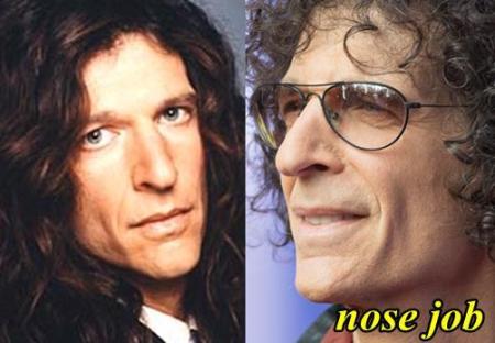 Howard Stern Plastic Surgery