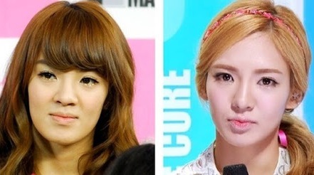 Hyoyeon Plastic Surgery