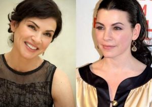 Julianna Margulies Plastic Surgery