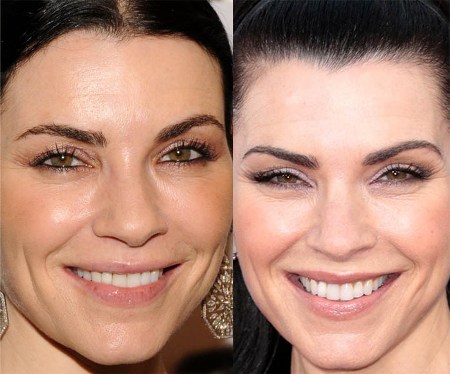 Julianna Margulies Plastic Surgery