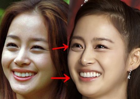 Kim Tae Hee Plastic Surgery