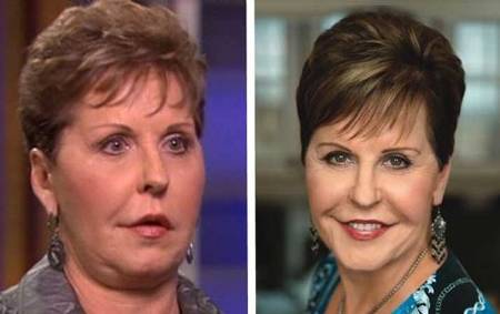 Preacher Joyce Meyer Plastic Surgery I Want To Look My Best For God Surgery Lists