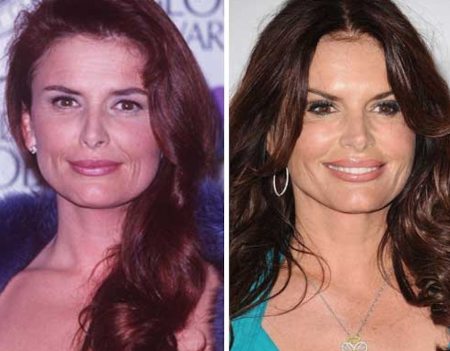 Roma Downey Plastic Surgery