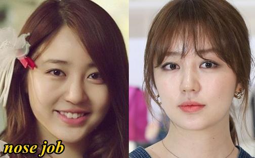 Yoon Eun Hye Plastic Surgery